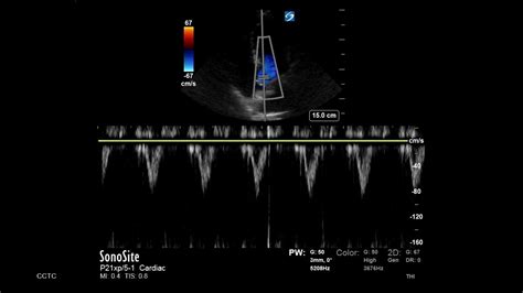 how to measure lvot gradient.